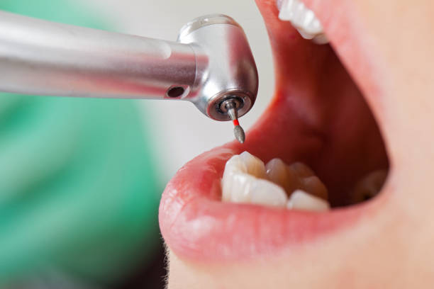 Best Emergency Root Canal Treatment in Tuskegee, AL